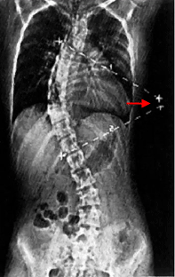 Scoliosis Scoliosis (13).gif